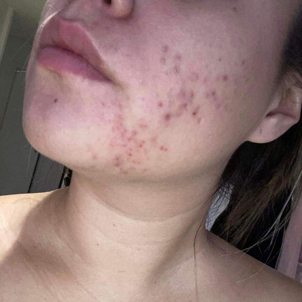 Before – Linnea, 17